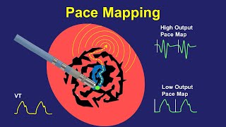 Pace Mapping Principles and Pitfalls [upl. by Aetnahc206]