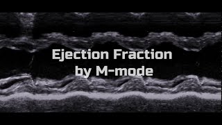 Ejection Fraction by MMode [upl. by Anelam564]