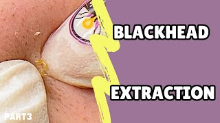 Blackhead extraction Relax with bye pimple💜 [upl. by Ettenad542]