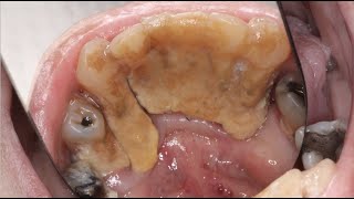 MASSIVE Calculus Buildup  Severe Gum Disease Case [upl. by Hephzipah]