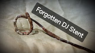 Forgotten DJ Stent  Cystoscopic Removal  Dr Tayyab Riaz Ch [upl. by Abby]