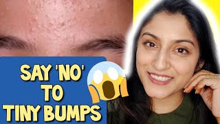 7 Days Challenge 😲 Treat TINY BUMPS on FOREHEADSFACE NATURALLY  100 Works Home Remedy [upl. by Nylinnej]