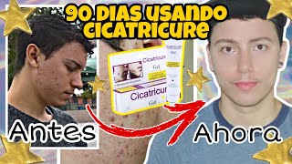 El mejor tratamiento para eliminar CICATRICES de ACNÉ Use CICATRICURE por 90 días y ¡esto pasó [upl. by Terrilyn]