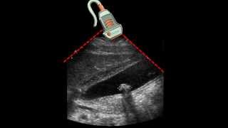 Ultrasound of Gallbladder amp Gallstone [upl. by Naillimixam]