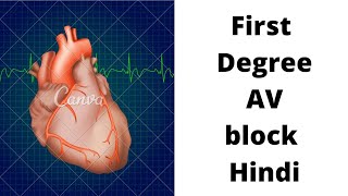 ECG test  ECG kaise karte hai  First degree atrioventricular blockAV block Heart block in hindi [upl. by Aenej483]