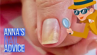 Nail Separation  Causes  Early Treatment of Onycholysis Annas Nail Advice [upl. by Publea72]