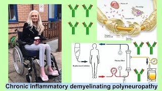 chronic inflammatory demyelinating polyneuropathy [upl. by Blakeley]