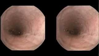 Esophageal varices detected by capsule endoscopy [upl. by Barbara]