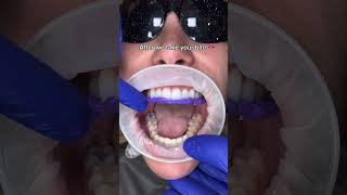 How we make bottom temporary smile before cementing permanent veneers teethclean 🦷beadrepair [upl. by Mihsah50]