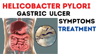 Helicobacter Pylori infection pathogenesis treatment [upl. by Nasar391]