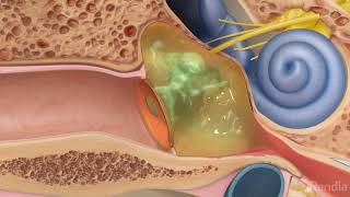 Ruptured eardrum perforated eardrumTreatment for eardrum rupture [upl. by Rubel]