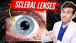 Scleral Lenses for Keratoconus 7 Facts You Need to Know [upl. by Novled]