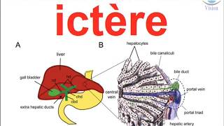 Diagnostique Medical de lictere a bilirubine conjuguée ou non physiopathologie néonatal nouveau né [upl. by Elocin629]