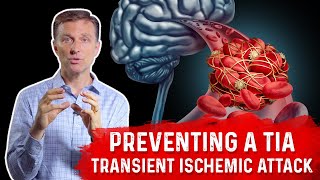 How To Prevent TIA Transient Ischemic Attack MiniStroke – DrBerg [upl. by Mccreery]