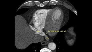 Competent Thebesian valve [upl. by Shepherd]