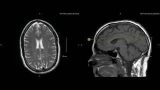 Unremarkable NonContrast Brain MRI Axial T2Example 1 [upl. by Nevil]