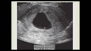 Ultrasound diagnosis of non viable early pregnancy [upl. by Marlette]