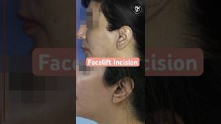 Facelift Incisions  Facelift Surgery Before After  Facelift Surgery in Hindi  SB Aesthetics [upl. by Lleneg]