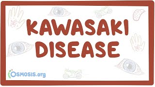 Kawasaki disease  an Osmosis Preview [upl. by Enneiluj]