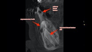 Extraction of Supernumarary Tooth and Exposure of Impacted Lower Lateral Incisor For Orthodontic Eru [upl. by Eveleen540]