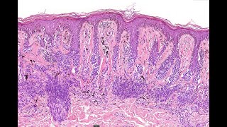 Dysplastic nevus re visited 2024 McKee [upl. by Yanahs]