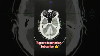 ncct head pathology detail report description radiology anatomy pathology hemantkushwah3453 [upl. by Loralee]