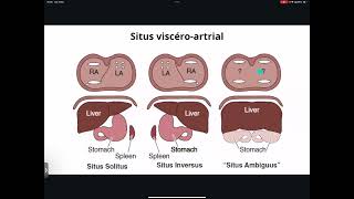 CSCWebinar 008  Single ventricule  Les Ventricules uniques [upl. by Ataner]