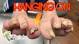 Why Its Important to Get Your Nails Trimmed Starring a Loose Nail [upl. by Ilahtan]