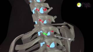 Cervical facet joint injections under Xray guidance [upl. by Adnylam809]