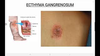 Ecthyma Gangrenosum [upl. by Towland]