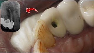 Root Canal Treatment of Maxillary Lateral Incisor Through The Crown [upl. by Greenwood]