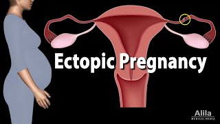 Ectopic Pregnancy Animation [upl. by Rovner431]