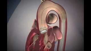 Transcatheter Aortic Valve Replacement TAVR at Stony Brook [upl. by Repsag]