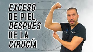 Exceso de Piel Después de la Cirugía  Manga Gástrica  Preguntas Frecuentes [upl. by Dnyletak]