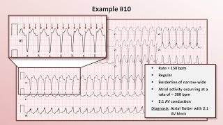 Intro to EKG Interpretation  Practicing Tachyarrhythmia Identification [upl. by Natassia127]