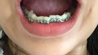 Timelapse 1 year Before and After Braces lower Shorts braces [upl. by Duarte]