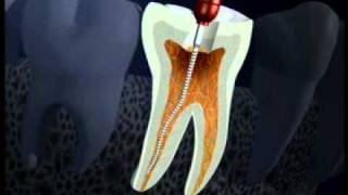 Endodoncia en casos simples [upl. by Porett]