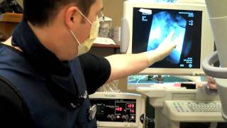 Cervical Radio Frequency Ablation [upl. by Wolbrom174]