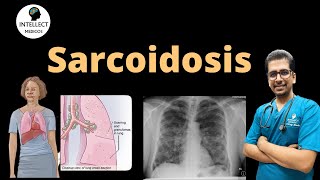 Sarcoidosis Answer to MCQ explaining Clinical features staging Diagnosis amp Treatment [upl. by Tenej]