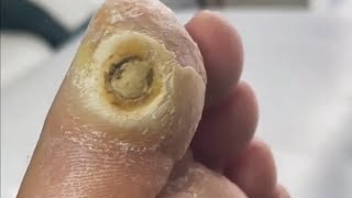 Pedicure video34，vertical plantaris，plantar wart [upl. by Nevets939]