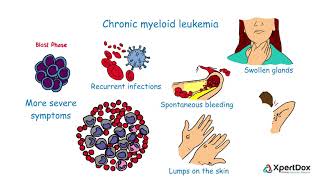 What is Chronic myeloid leukemia [upl. by Nedroj872]