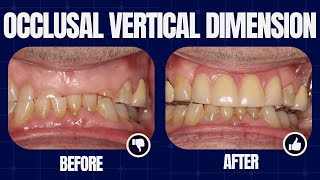 Vertical Dimension  Dont Be Scared  PDP197 [upl. by Afinom]