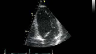 APICAL VIEW 4 CHAMBERS  NORMAL STUDY [upl. by Kiel]