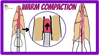 ENDODONTICS  OBTURATION TECHNIQUES  Warm Vertical Compaction technique [upl. by Zilevi]