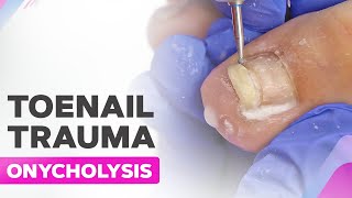 Toenail Trauma  Onycholysis  Cleanup [upl. by Peltier375]