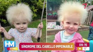 El PELO para CUALQUIER LADO ¿tendrás el SÍNDROME del CABELLO IMPEINABLE [upl. by Anelram]