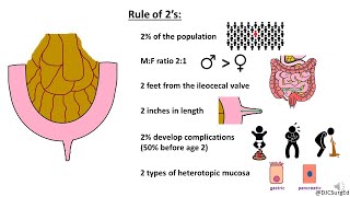 Meckel’s Diverticulum [upl. by Nonnaehr]