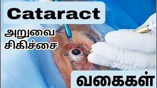 Cataract அறுவை சிகிச்சை வகைகள்  Every type explained clearly  Ophthalmology  MBBS [upl. by Drareg]