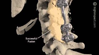 Volumated Post Surgical Cervical Spine [upl. by Esaj]