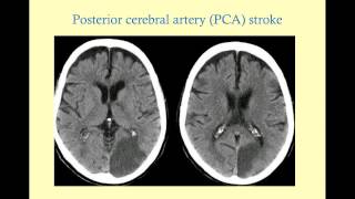 Stroke Syndromes older version with sound  CRASH Medical Review Series [upl. by Gordy118]